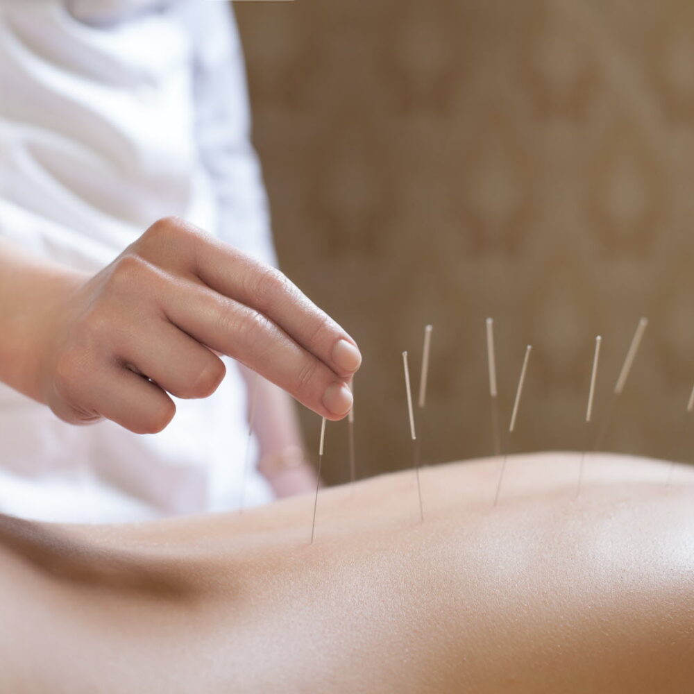 acupuncture1