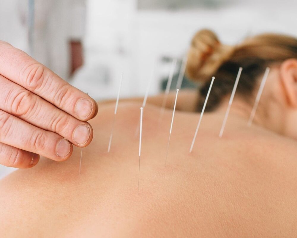 acupuncture5